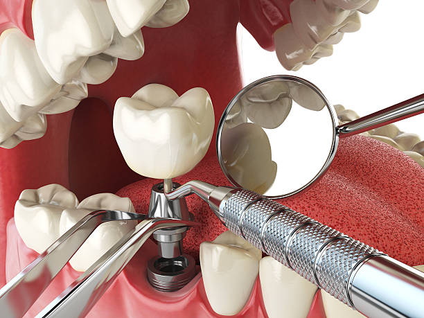 Best Emergency Denture Repair in Camp Springs, MD